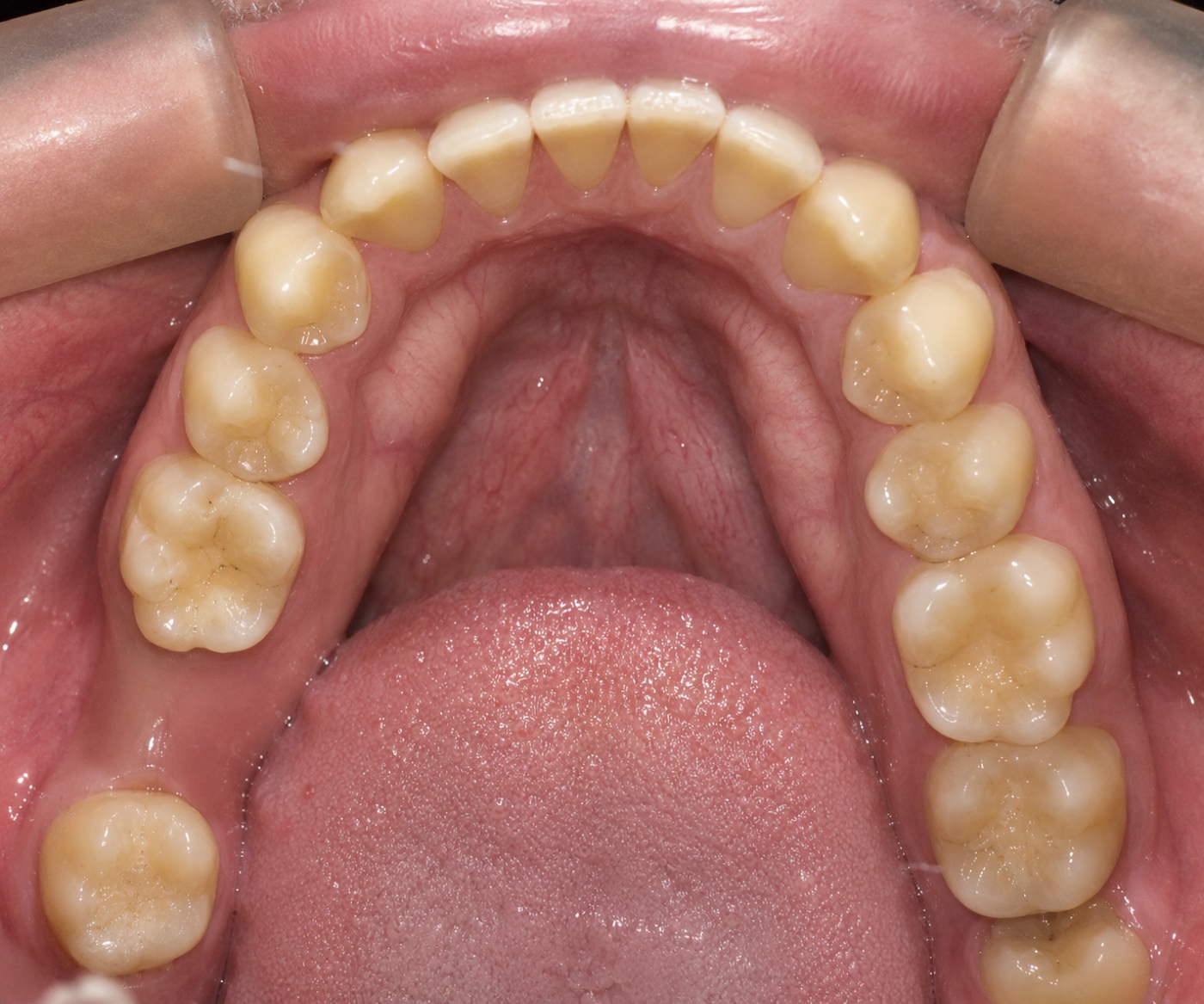 Vista oclusal inferior inicial del segundo caso clínico