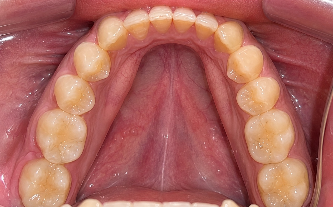 Vista oclusal inferior final del segundo caso clínico